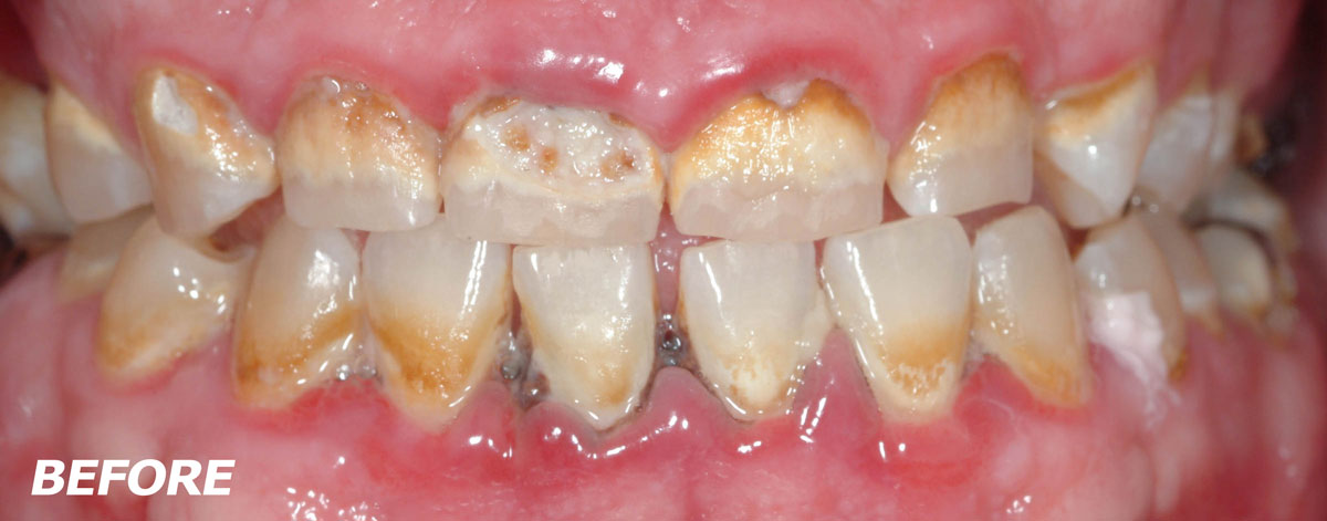 Gallery Case 2: Gum surgery and crowns before - Brooklyn, NY