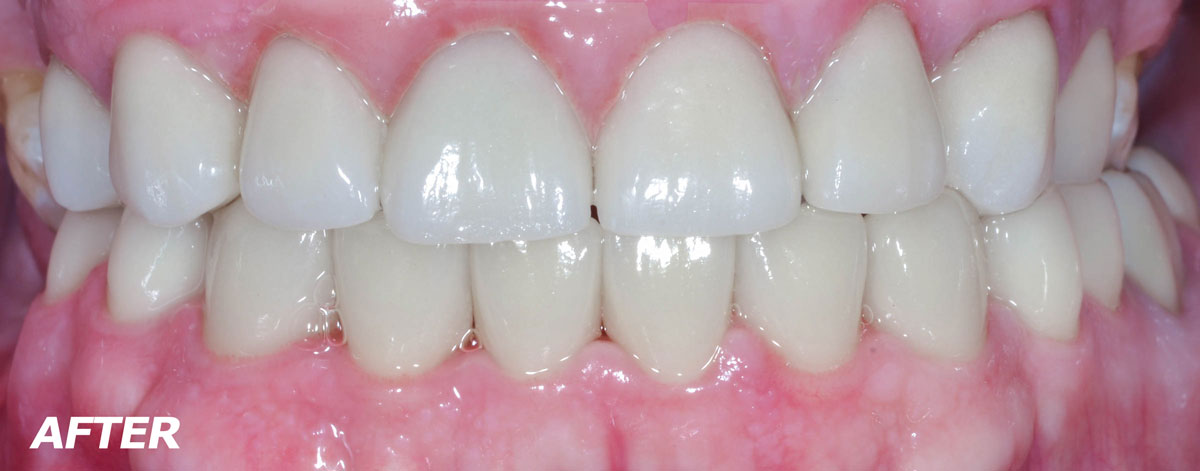 Gallery Case 2: Gum surgery and crowns after - Brooklyn, NY