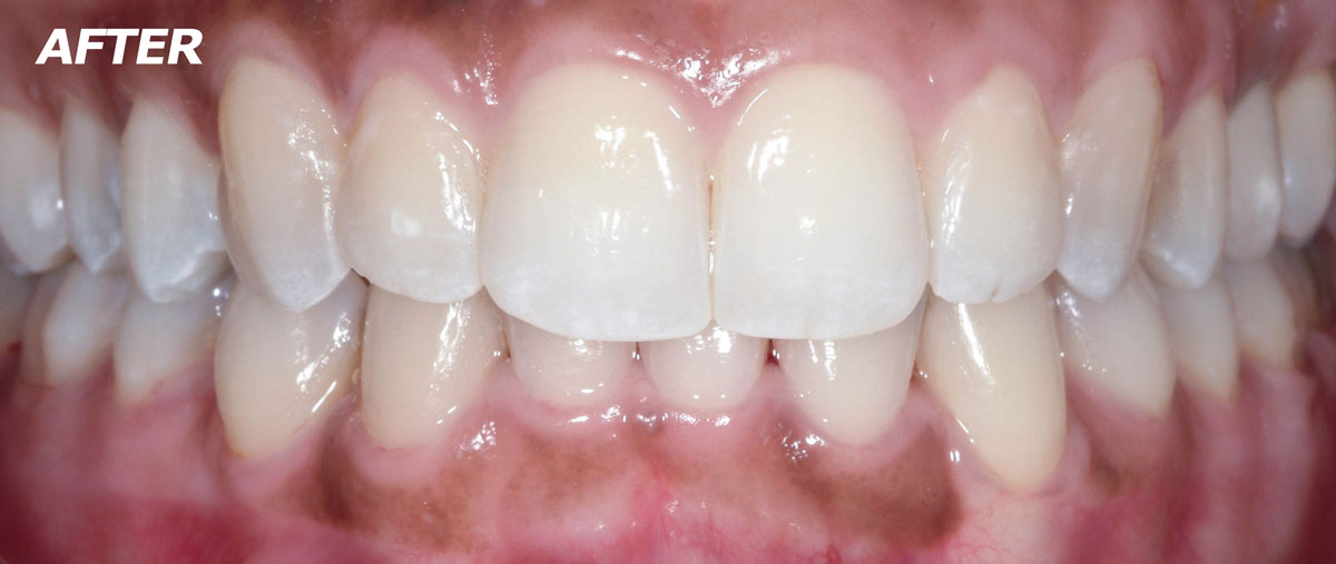 Gallery Case 3 Invisalign after - Brooklyn, NY