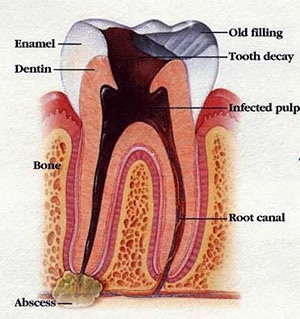 Root Canal Therapy - Brooklyn, NY