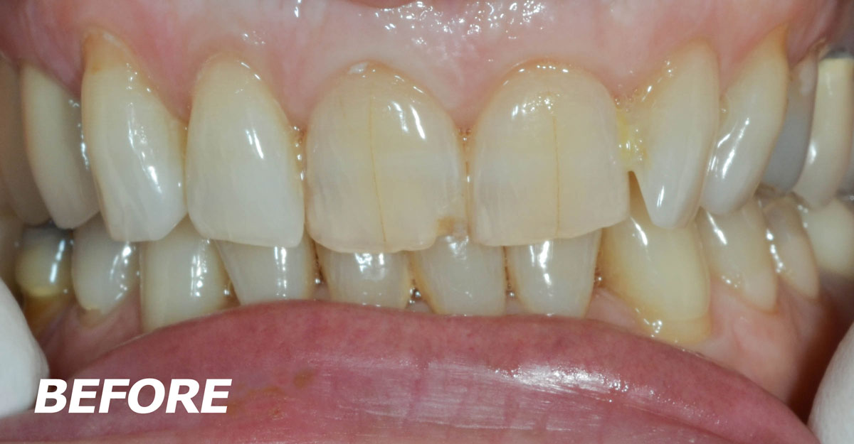 Gallery Case 4 Porcelain Veneers before - Brooklyn, NY