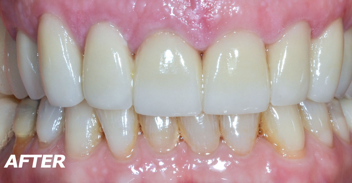 Gallery Case 4 Porcelain Veneers after - Brooklyn, NY